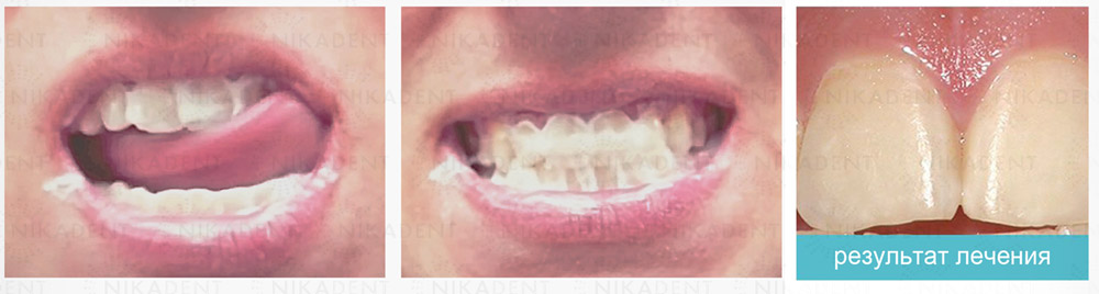 Tooth Mousse гель с био-доступными кальцием и фосфатом для реминерализации эмали и восстановления минерального баланса в полости рта