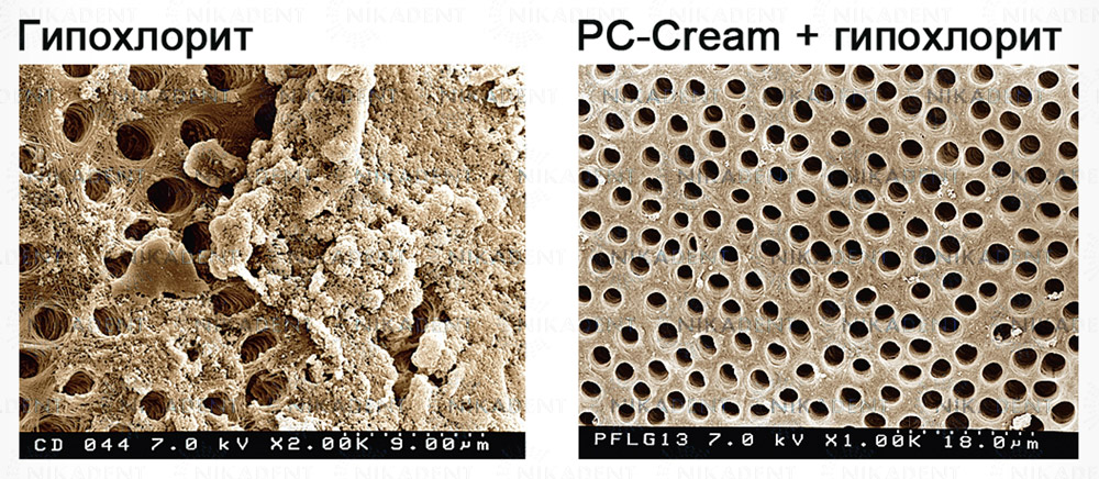 RC-Cream гель для химико-механической обработки облитерированных корневых каналов зубов.