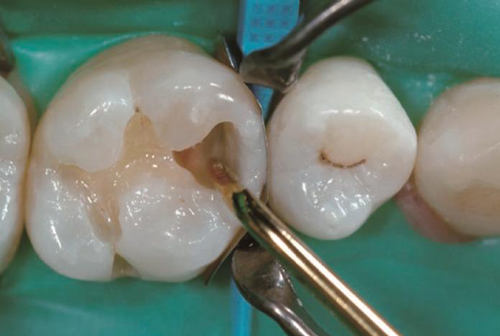 Восстановление контактного пункта жевательного зуба с помощью композита Estelite_Asteria