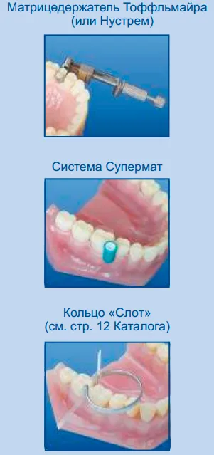Способы установки контурных пластиковых матриц