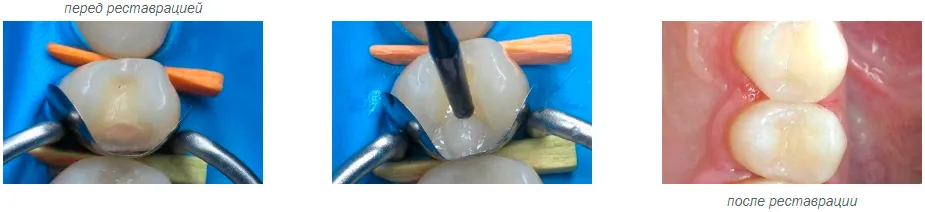 Матрицы секционные металлические TOP - инструкция