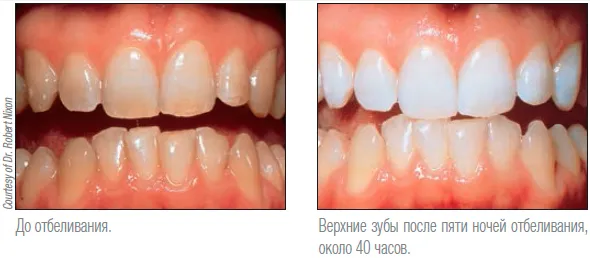 Opalescence PF