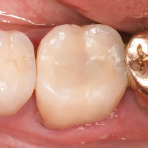 SDR Dentsply SDR Dentsply