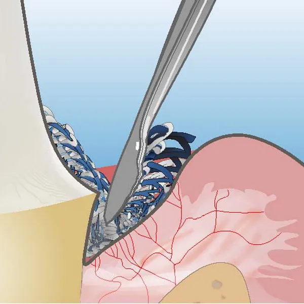 ultrapak_ultradent03.png