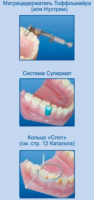Способы установки контурных пластиковых матриц