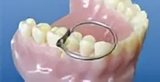 Установка с кольцом - этап 2