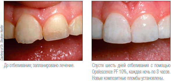 Opalescence PF
