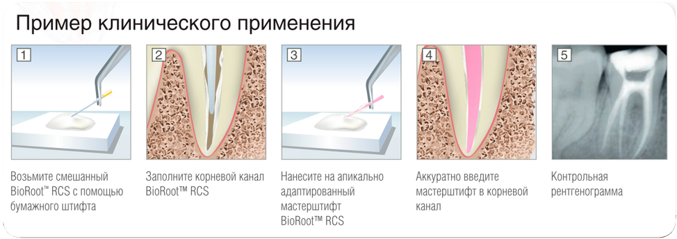 био роот септодонт