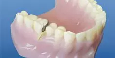 Установка с кольцом - этап 1