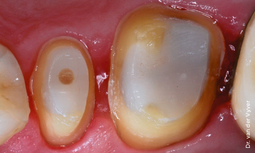 SDR Dentsply