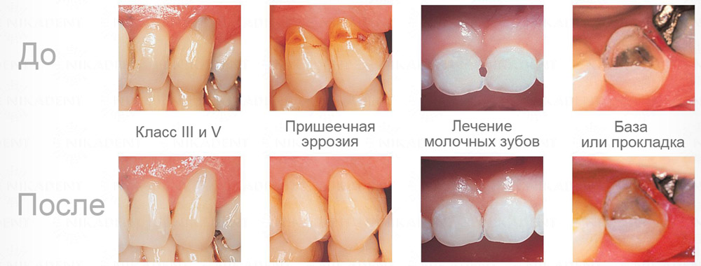 Fuji II LS СИЦ варианты использования