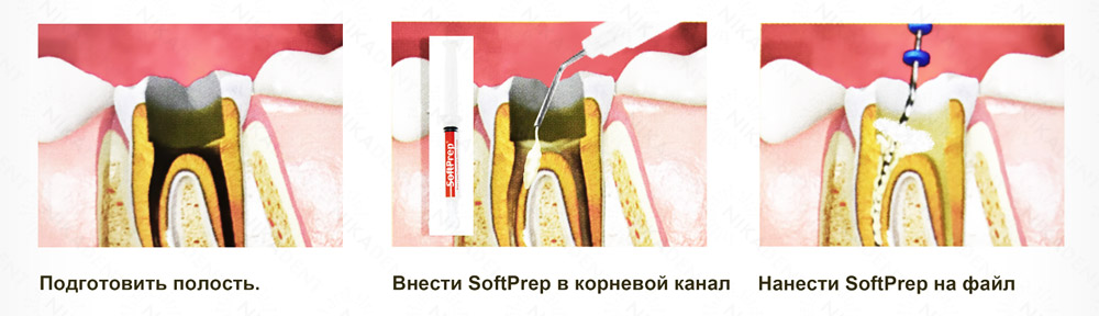 SoftPrep гель ЭДТА 17%