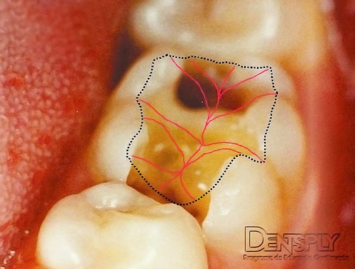 Esthet-X Dentsply