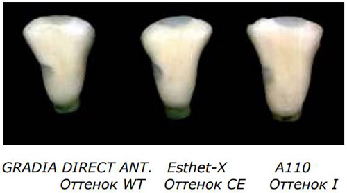 GRADIA DIRECT ANTERIOR и POSTERIOR