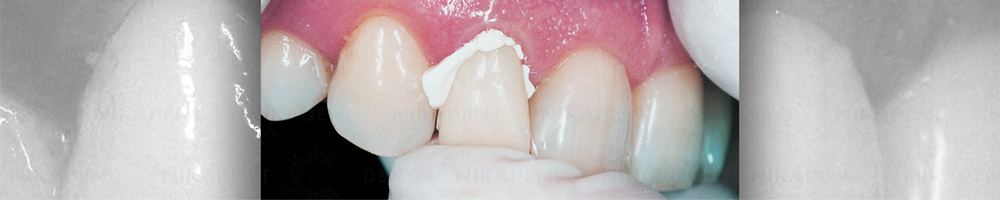 Freegenol временный безэвгенольный стоматологический цемент