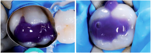 Gel Etchant