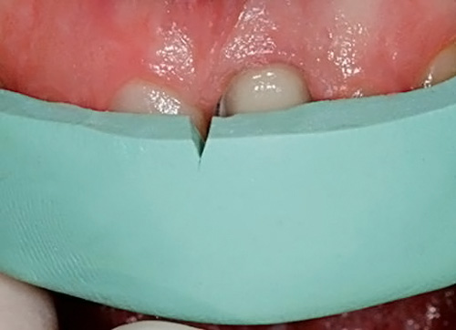 Установка силиконового ключа в полости рта.