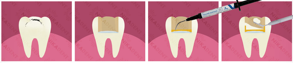 Денлайт Флоу - текучий композит для пломбирования зубов.