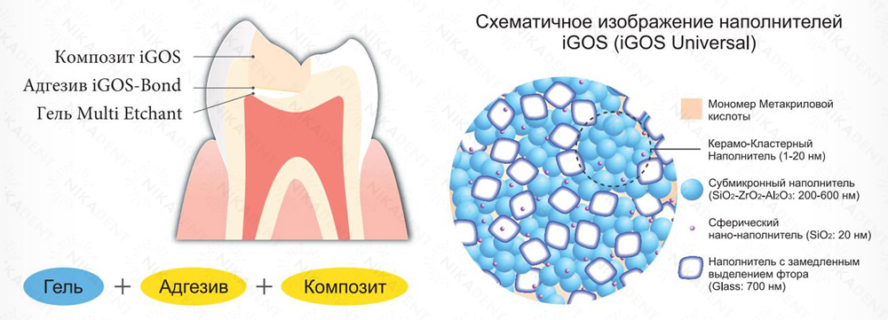 igos universal - светоотверждаемый композитный пломбировочный материал на основе керамо-кластерного наполнителя. Содержит цирконий.