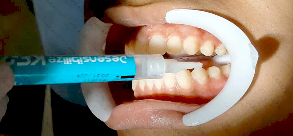 Десенсибилизирующий гель DESENSIBILIZE KF двойного действия для снижения чувствительности зубов. 