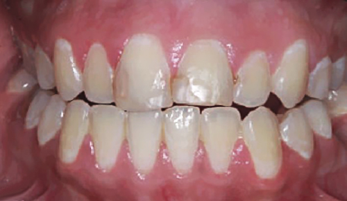 Фотография зубов перед началом лечения