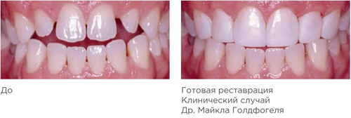 Spectrum TPH 3 Dentsply