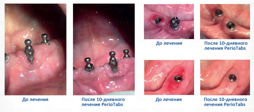 PerioTabs – инновационное гигиеническое средство для дезинфекции зубов и ротовой полости.