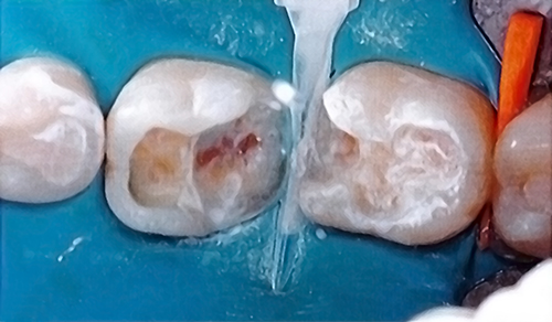 После нанесения жидкости № 2 на зубах остается тонкая белая пленка.
