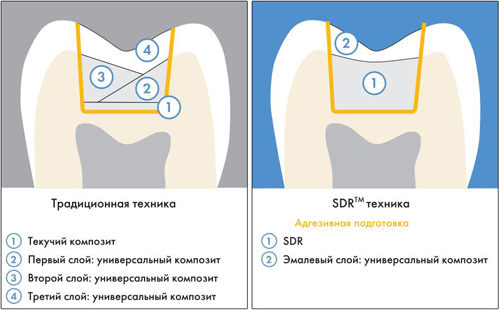 SDR Dentsply