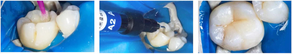 Filtek Bulk Fill Posterior – светоотверждаемый композит объемного внесения для пломбирования жевательных зубов.