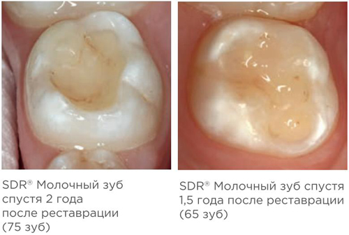 SDR Dentsply