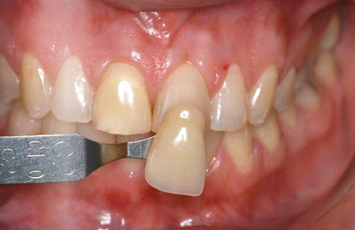 Esthet-X Dentsply