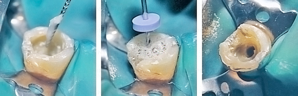 RC-Prep гель для химико-механической обработки облитерированных корневых каналов зубов.