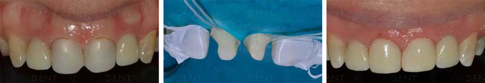 Denfil – светоотверждаемый композитный стоматологический материал.