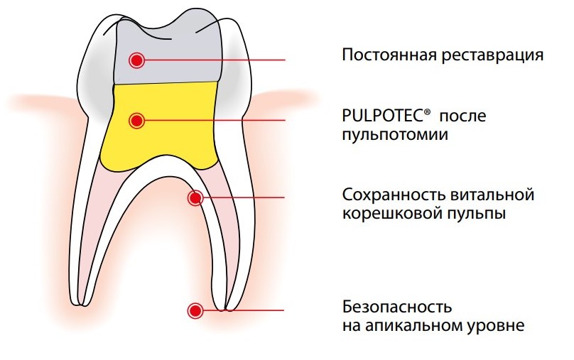 Метод витальной ампутации