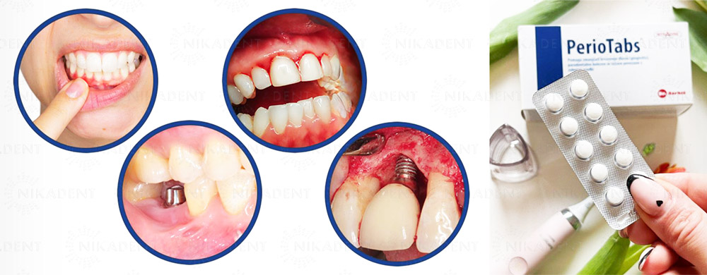 PerioTabs – инновационное гигиеническое средство для дезинфекции зубов и ротовой полости.