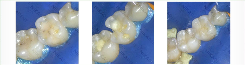 EsCom 100светополимеризующийся композит, идеально подходит для всех полостей фронтальных и боковых (жевательных) зубов.