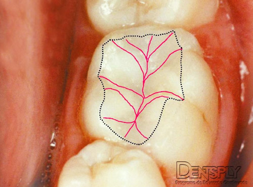 Esthet-X Dentsply