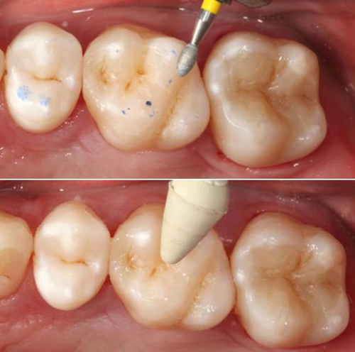 ceram.x SphereTEC Dentsply