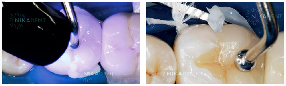 Variolink Esthetic - композитный цемент для фиксации виниров, вкладок, накладок, коронок Variolink Esthetic - композитный цемент для фиксации виниров, вкладок, накладок, коронок
