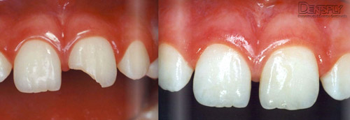 Esthet-X Dentsply