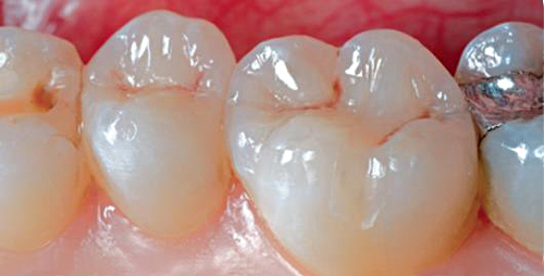 Двухслойная реставрация жевательных зубов материалом Herculite XRV Ultra