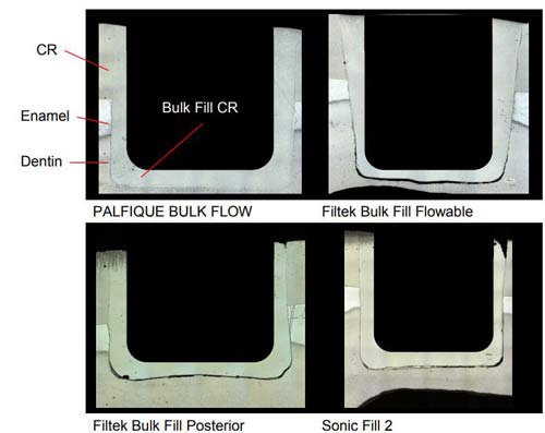 Estelite Bulk Fill Flow