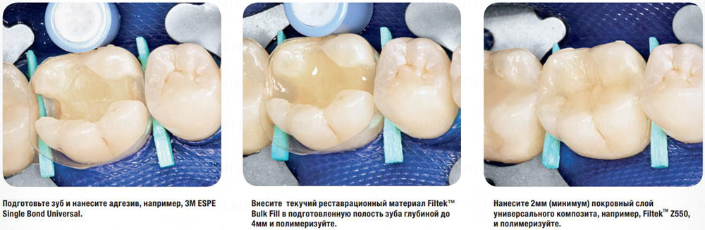 Filtek Bulk Fill прокладочный стоматологический материал с возможностью объемного внесения.