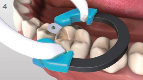 Матрицы Palodent Dentsply