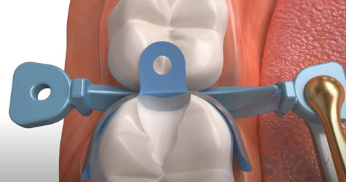 Матрицы Palodent Dentsply