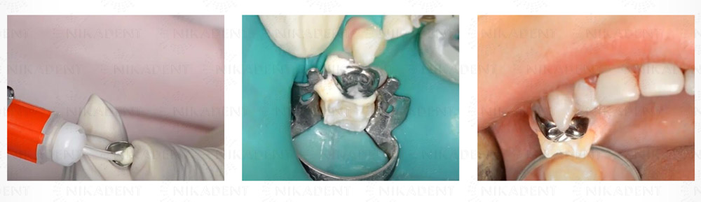 Stainless Steel Crowns – стальные коронки для молочных зубов.