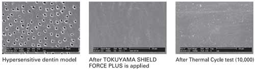 TOKUYAMA® SHIELD FORCE PLUS