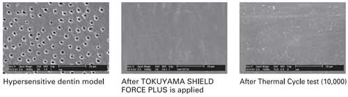TOKUYAMA® SHIELD FORCE PLUS TOKUYAMA® SHIELD FORCE PLUS