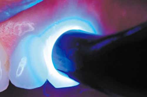 TOKUYAMA® SHIELD FORCE PLUS TOKUYAMA® SHIELD FORCE PLUS